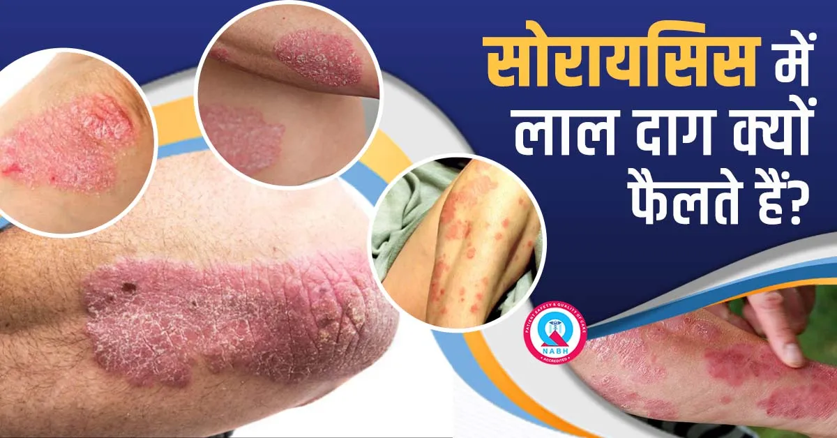 सोरायसिस-में-लाल-दाग-क्यों-फैलते-हैं